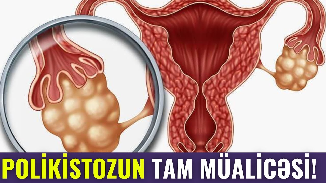 DİQQƏT Polikistoz Xəstəlik Deyil! - Qadınlar İzləsin
