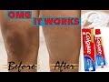 How to LIGHTEN DARK KNEES, KNUCKLES, ELBOWS in just 15MINS with COLGATE TOOTHPASTE