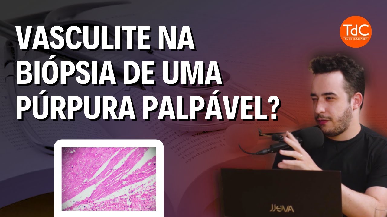 Thumbnail - Vasculite cutânea: Achados histopatológicos