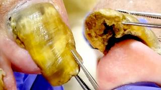 Gentle Pedicure For Grandpa To Remove Fungal Infection【Xue Yidao】