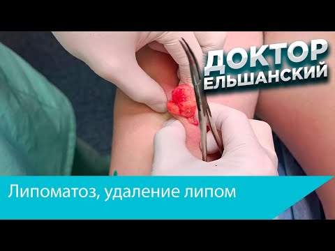 Липоматоз, удаление липом
