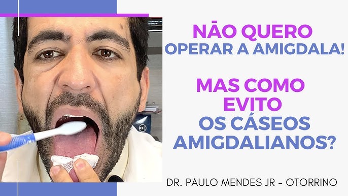 Você já ouviu falar do Caseum Amigdaliano? – Dr. Mohamad Saada Otorrino