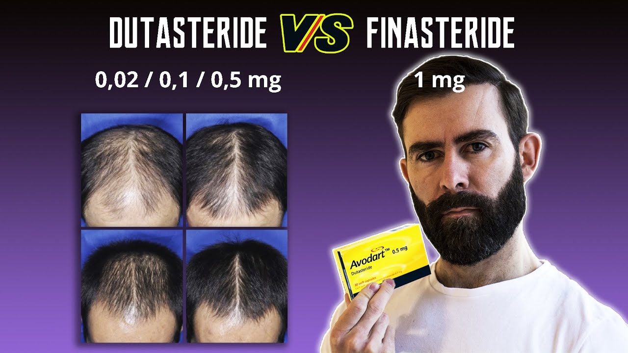 Diferentes Dosis De Dutasteride Vs Finasteride YouTube