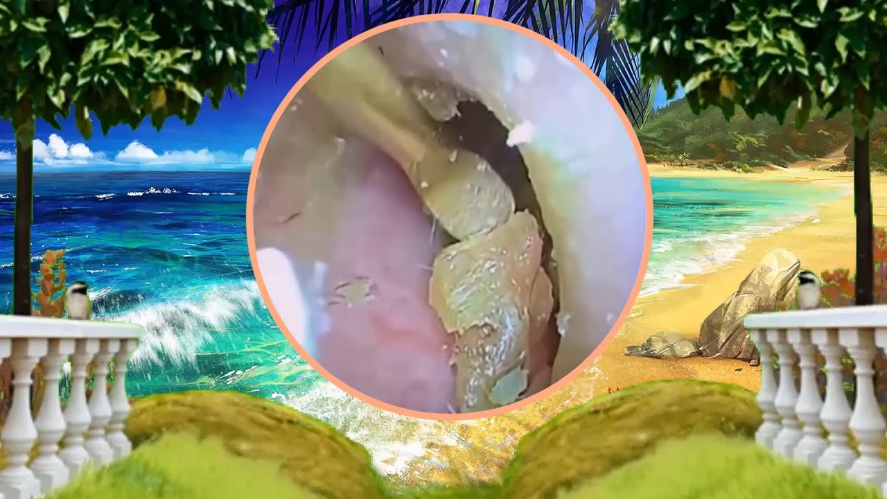 Satisfying Ear Wax Removal With Dr Zhao Video 206 YouTube