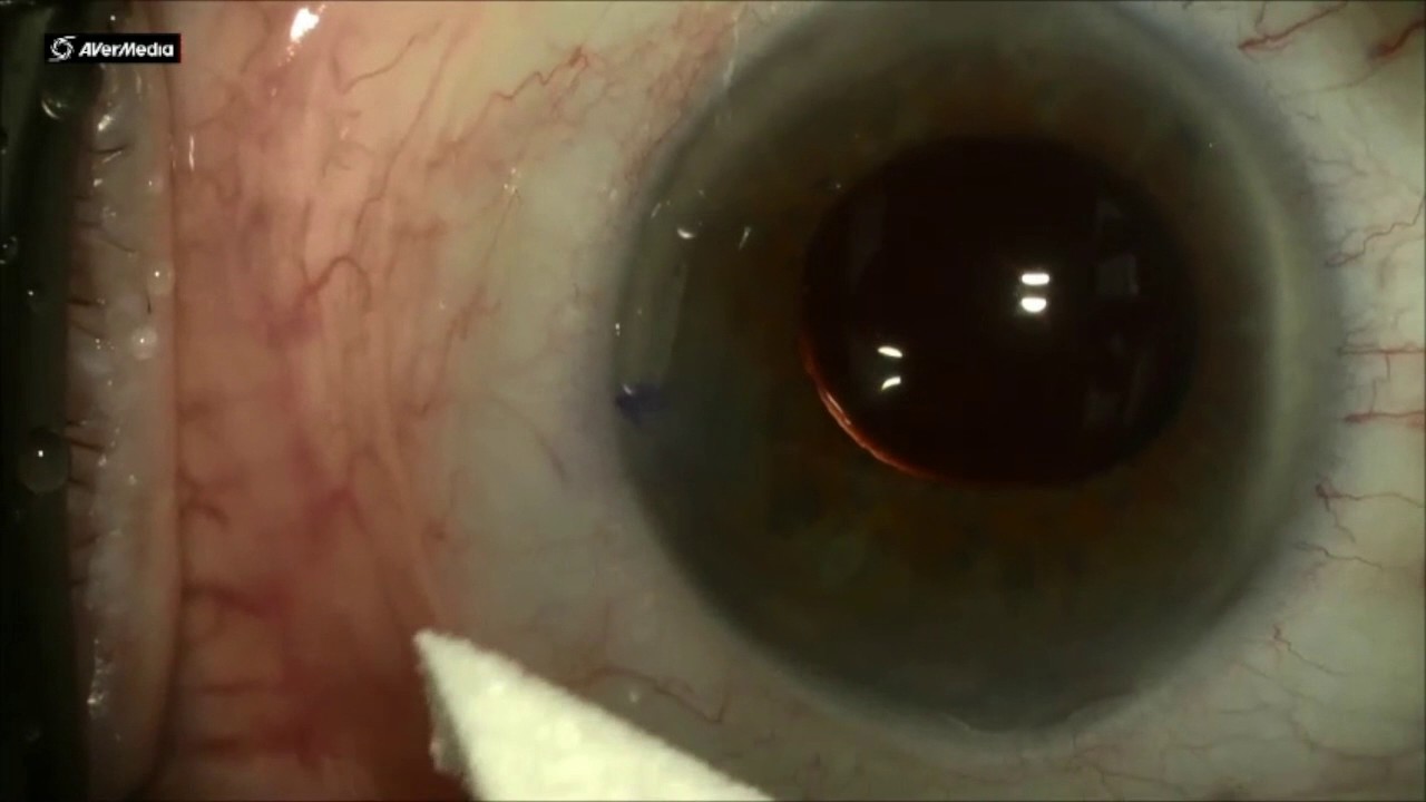 http://clinicaltrials.gov Phacoemulsification: Check for Leakage of Wound