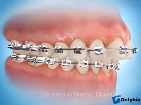 Video: Cara Mengurangkan Kawat Gigi Anda (dengan Gambar)