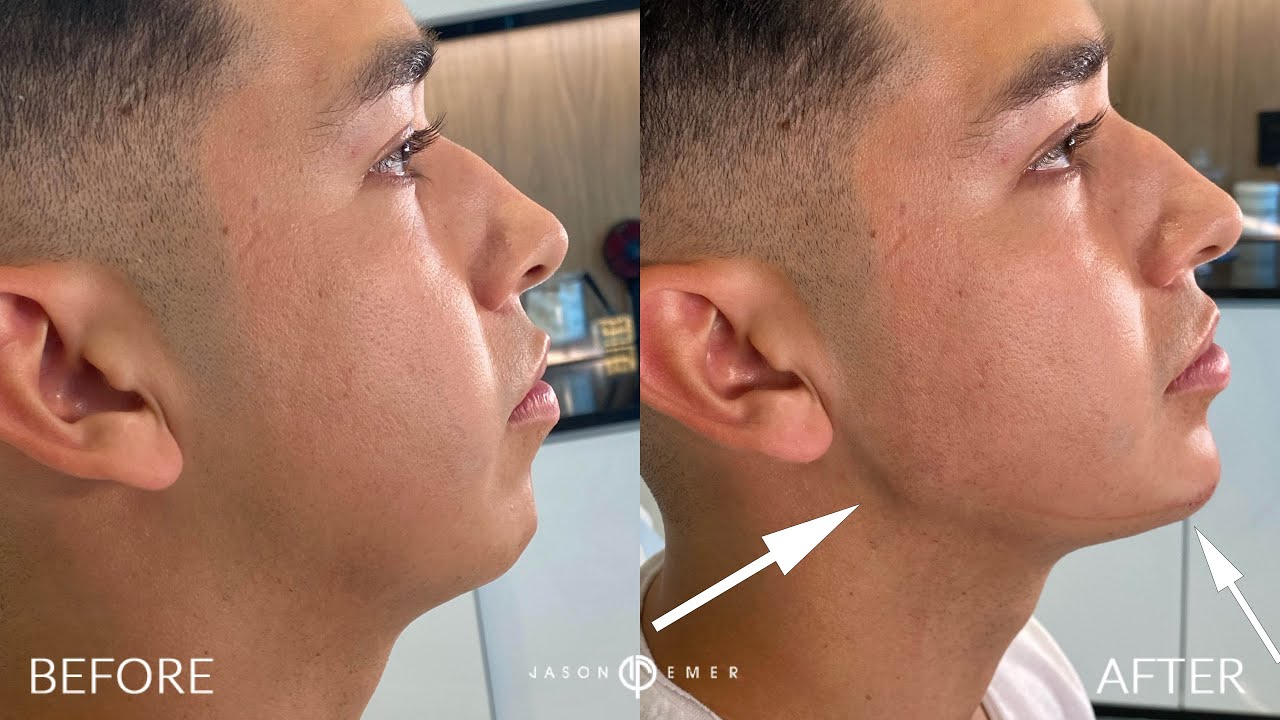 Male Facial Sculpting Defining The Jawline And Chin With Radiesse
