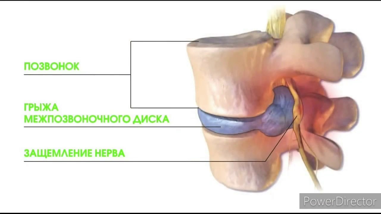Защемление в поясничном отделе позвоночника. Грыжа позвоночника защемление нерва. Межпозвоночная грыжа пережала нерв. Защемление межпозвоночного диска. Заземление позвоночного диска.