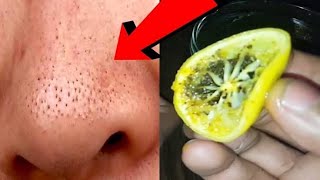 Remove Blackheads Naturally At Home | Get Rid Of Blackheads, Whiteheads, Open Pores at home screenshot 2