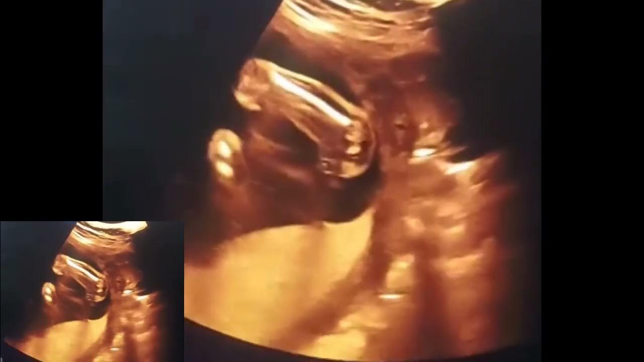 Diamniotic Twin twin Syndrome With Regressing Fetus F1 Fetus 2 Gross diamniotic-twin-twin-syndrome-with-regressing-fetus-f1-fetus-2-gross