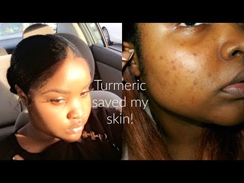 The mask that saved my life/Got rid of my acne scarring over night! (Turmeric)