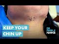 Keep Your Chin Up! Dr Pimple Popper Removes Chin Lipoma