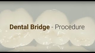 Dental Bridge - Procedure