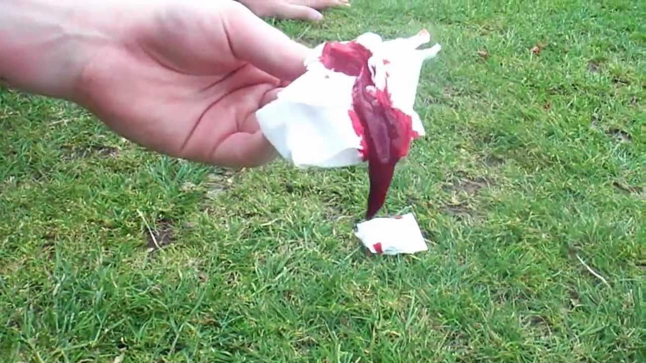 Nose Bleed blood clot - YouTube