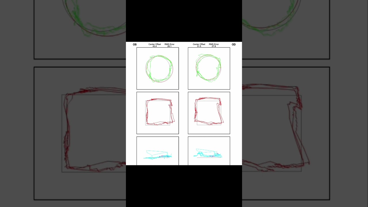 “Can you tell my anxiety got so much better since wearing the prism glasses?” That’s what my patient