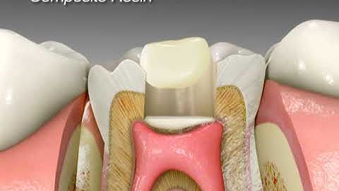 스피덴트-Base it