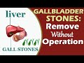 Gallbladder stones  what you should do dr chetan mahajan