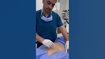 طريقة استخراج المعدة بعد عملية تكميم المعدة الميني Mini Sleeve 