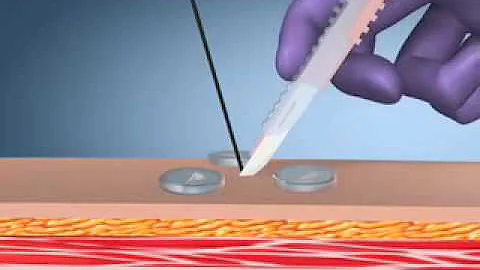 Kimberly-Clark MIC* J/TJ Introducer Kits - Endosco...