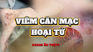 Phần 37: Bệnh Viêm cân mạc hoại tử - Virus ăn thịt người?.