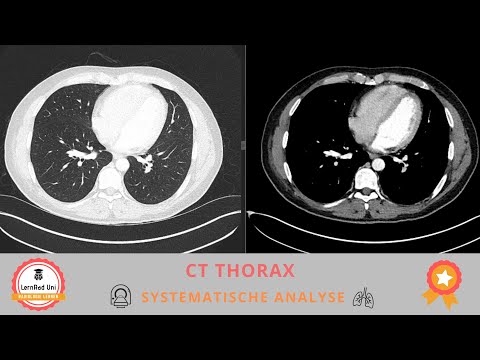 Video: Was ist ein CT-bewerteter Draht?