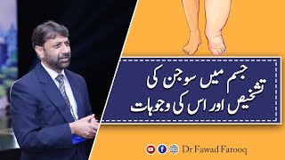 Edema or Sojan kya or kyun hoti hay.Urdu/Hindi Dr.Fawad Farooq