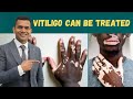 Vitiligo( Leucoderma ) Can Be Treated | Herbs And Vitamins To Treat Vitiligo - Dr. Vivek Joshi