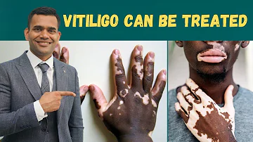 Vitiligo( Leucoderma ) Can Be Treated | Herbs And Vitamins To Treat Vitiligo - Dr. Vivek Joshi