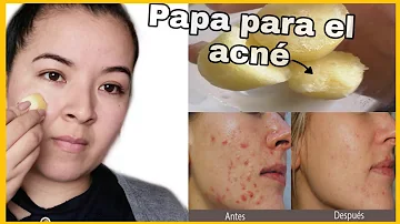 ¿Cómo utilizar las patatas para las cicatrices del acné?