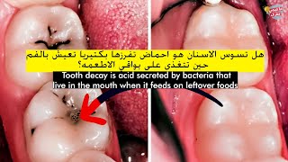ما هو تسوس الاسنان وهل هى بكتريا  و كيف تتجنبه -  tooth decay?/ prevention