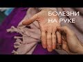 Хиромантия. Болезни на руке