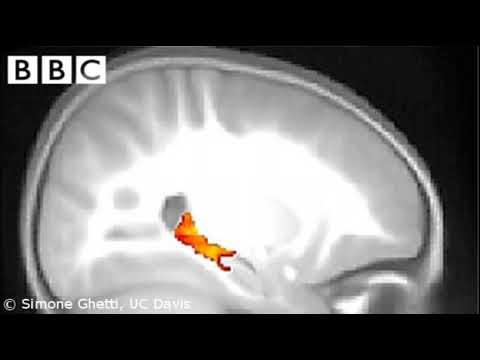 BBC Radio Kent Interview With Dr Amir Homayoun Javadi