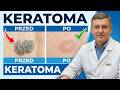 Keratoma Jak pozbyć się w 14 dni