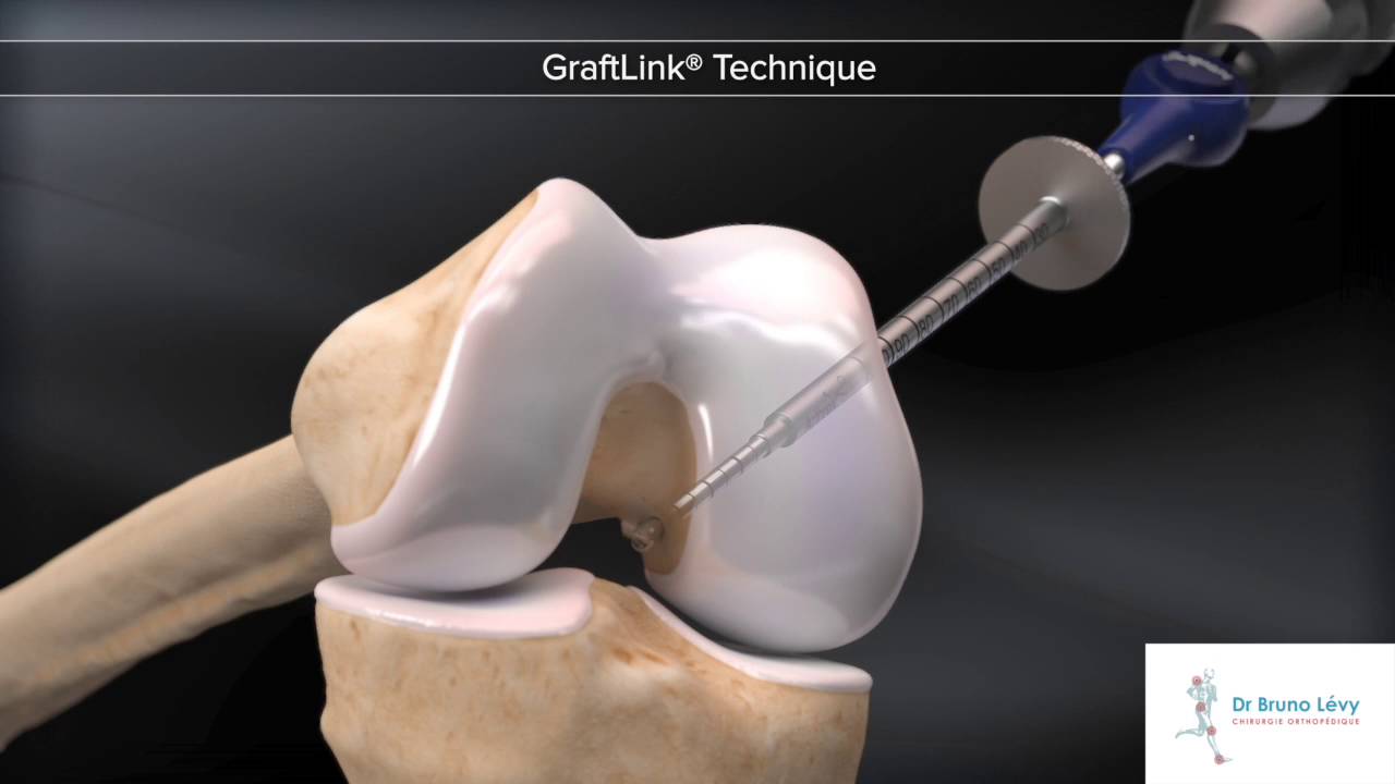 Dr Bruno Lévy - Ligamentoplastie du ligament croisé antérieur sous arthroscopie