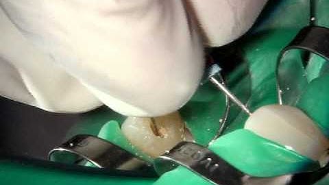 Working Length Determination