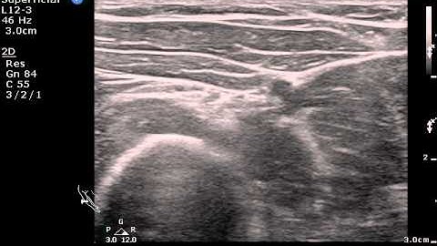 Radial nerve long tracing (from forearm to wrist)