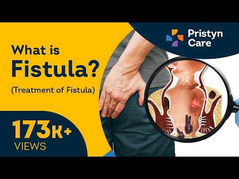 Video: Kaip diagnozuoti fistules?