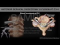 Anterior Cervical Discectomy & Fusion at C3-4