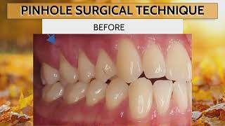 Dr. Nemeth's Success in Reversing Gum Recession 🦷 🔄