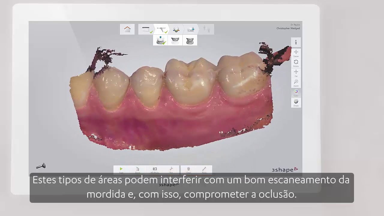 configuração significado 3Shape TRIOS - Estratégia de escaneamento - Mordida