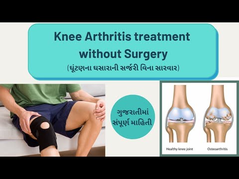 How to treat knee osteoarthritis without Surgery? #kneearthritis #treatment #ગુજરાતી