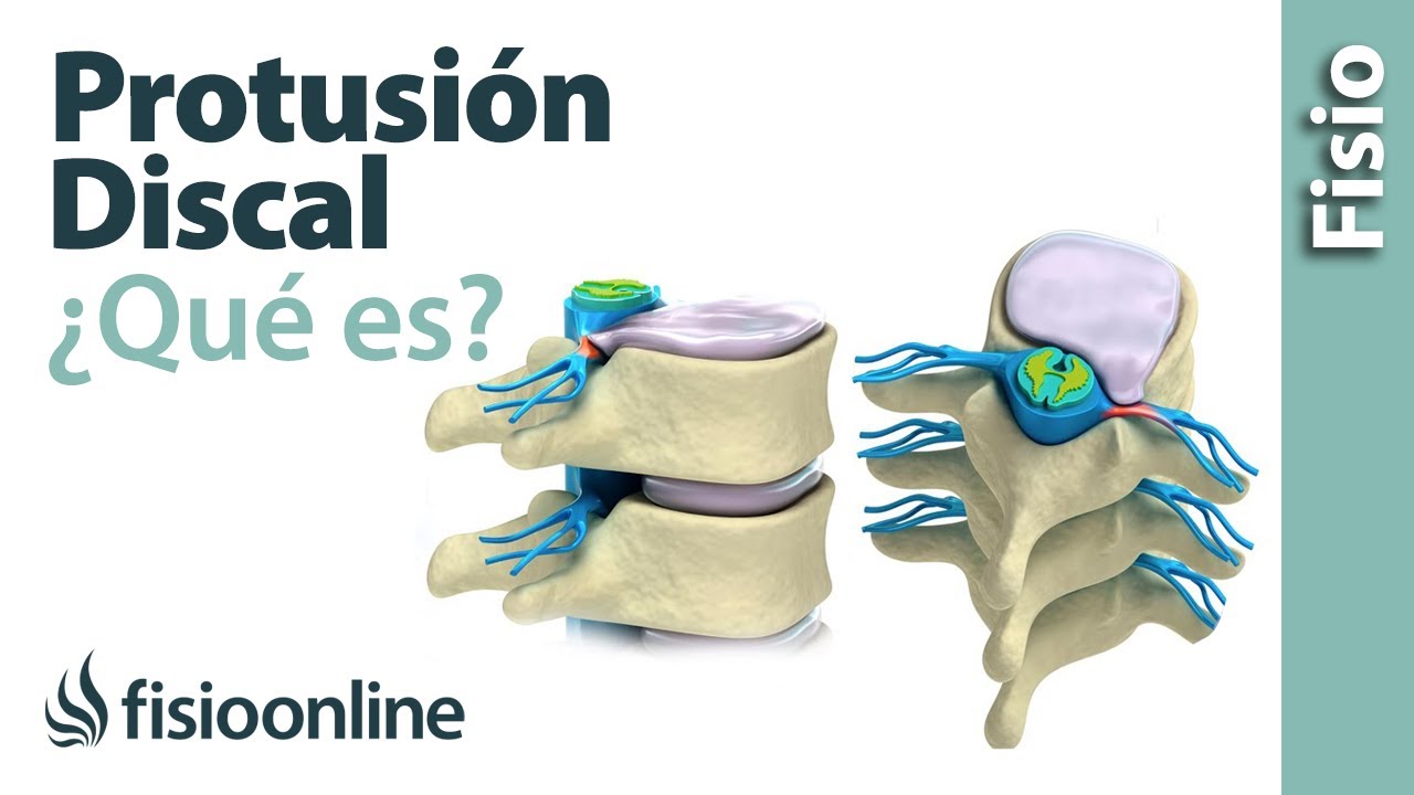 Cómo vivir con una protrusión discal (con imágenes)