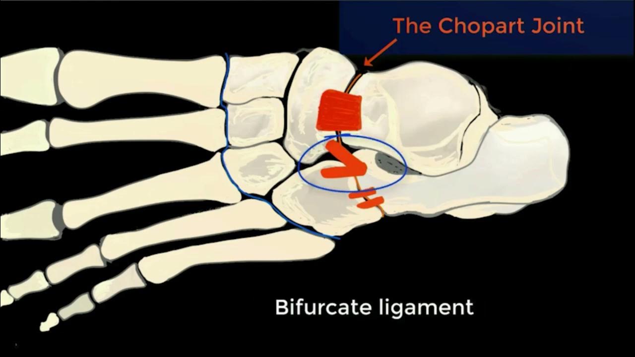 Imaging of Chopart (Midtarsal) Joint Complex: Normal Anatomy and  Posttraumatic Findings