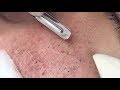 Full Blackhead Popping Video - HOT 2019 - Part 2 - Continue