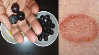 दाद-खाज दिनाय की जड़ से छुट्टी कर देगा | fungal infection treatment | ringworm removal | daad khaj