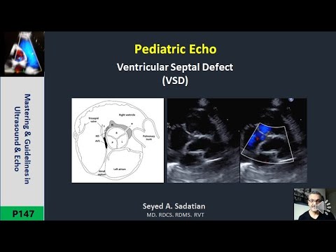 Pediatric Echo: Ventricular Septal Defect (VSD)