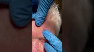 Popped a small forehead zit shorts pimplepopping  | CONTOUR DERMATOLOGY