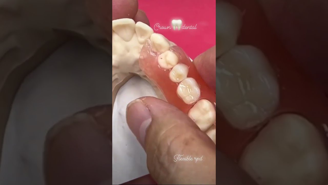 Flexible Rpd Removable Partial Denture Crown Dental