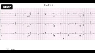Ecg Academy 12-Lead Chalktalk - Learn To Read Complex Ecgsekgs