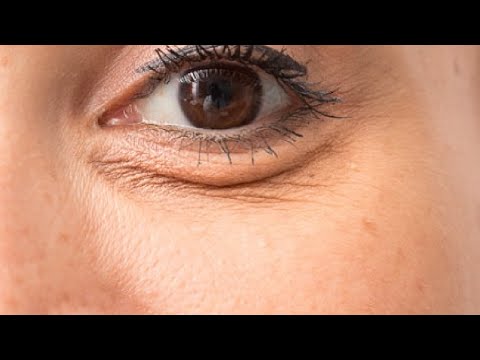 How To Fix Under Eye Wrinkles When Smiling